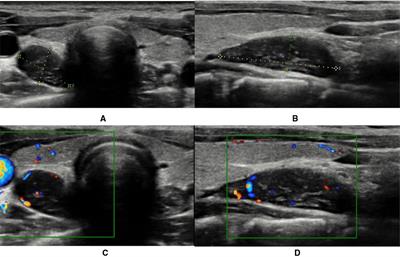 Hypercalcemia and Neurological Symptoms: A Rare Presentation of Hyperfunctioning Parathyroid Adenoma in an Adolescent